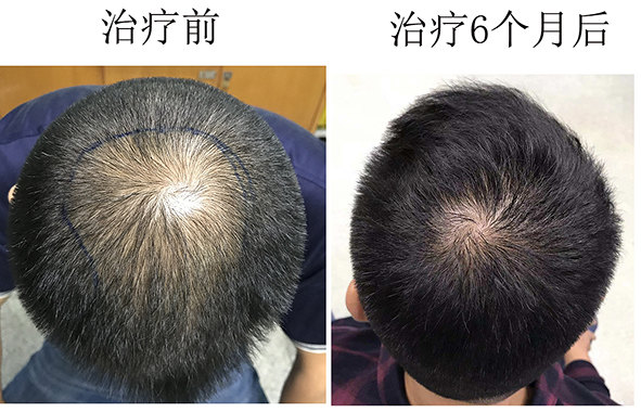怎么样治疗脱发能更彻底_海口治疗脱发医院