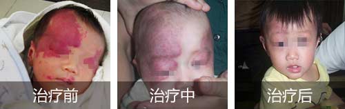 海口市皮肤医院做胎记切除手术么