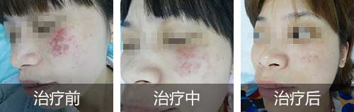 海南去除胎记哪里好