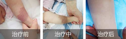海口去除太田痣哪家医院好