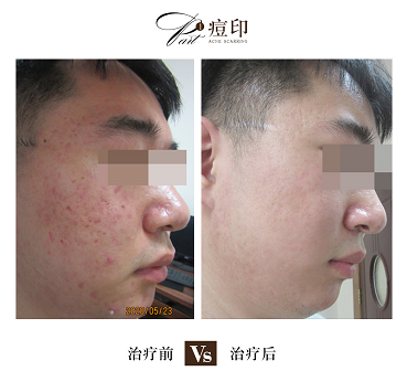 海口市哪家医院治疗痘印比较好